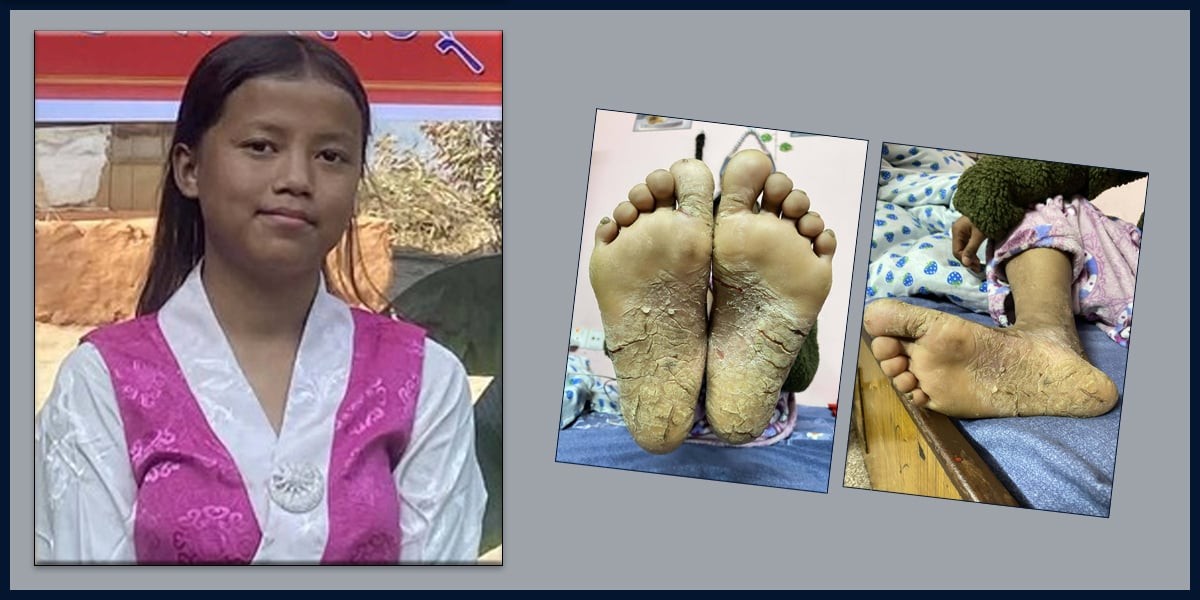 नुवाकोट पञ्चकन्याकी छाला रोगपीडित सुनिताको उपचारका लागि सहयोग संकलन